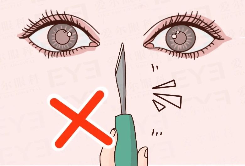 @近视手术过来人说实话，手术痛吗？插图(1)