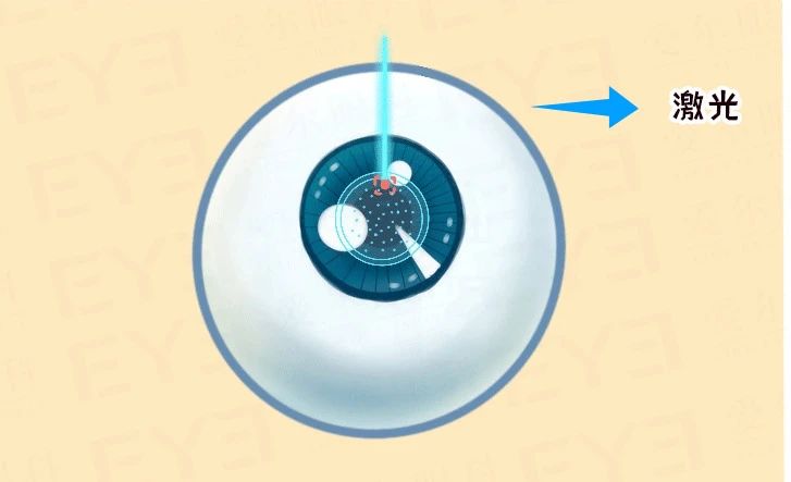 @近视手术过来人说实话，手术痛吗？插图(3)
