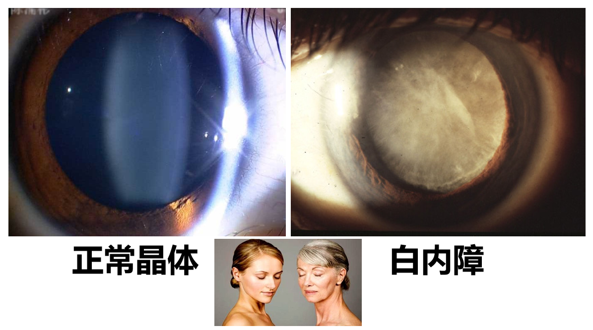 人老了一定会得白内障吗？插图