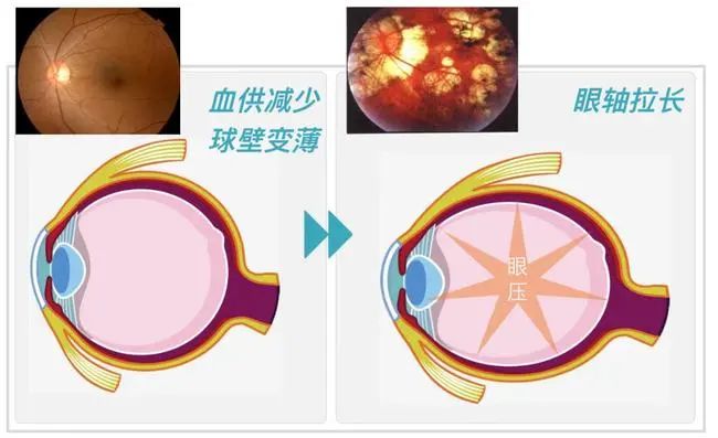 眼压测量的那些事儿！插图