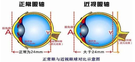 近视1000多度，做完近视手术能达到高清效果吗？插图