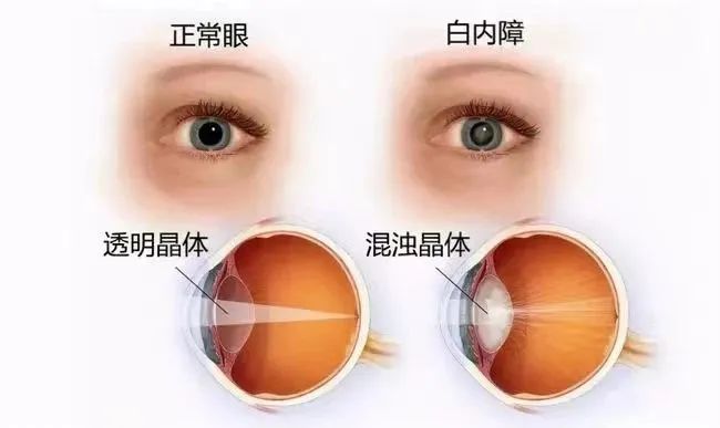 做了激光近视手术，真的会提前老花吗？插图(4)