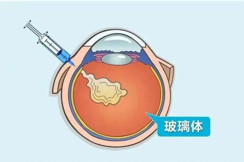 这些眼底手术，你了解多少？插图(2)