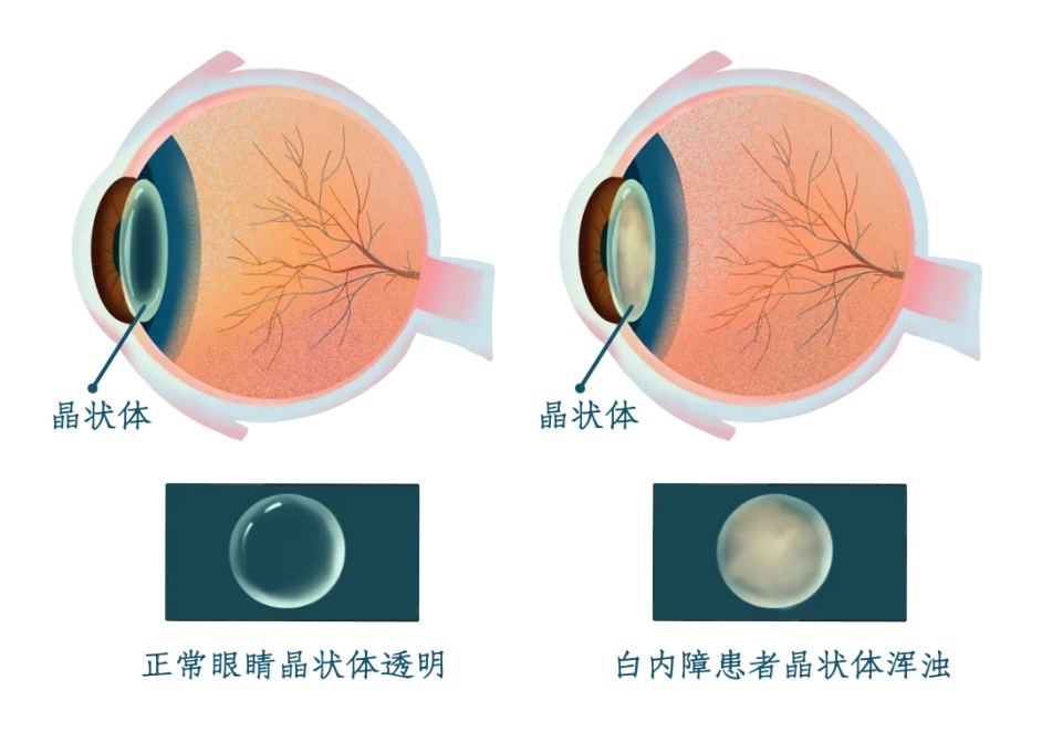 这几个小技巧，帮你为父母自测是否有白内障插图(1)