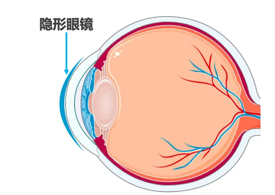 为什么要去专业医疗机构验配隐形眼镜？插图(1)