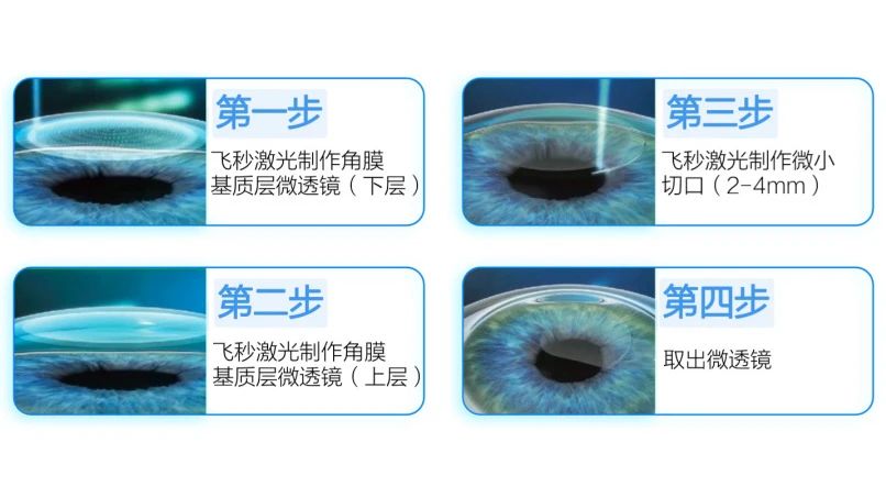 全飞秒VS半飞秒，究竟哪个好？插图(3)