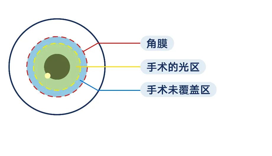 有的人做不了近视手术，竟是因为这项检查…插图(2)
