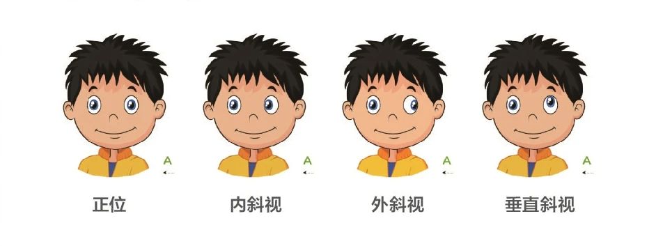歪头看东西就是斜视？儿童斜视简单自测，只要1分钟插图(1)