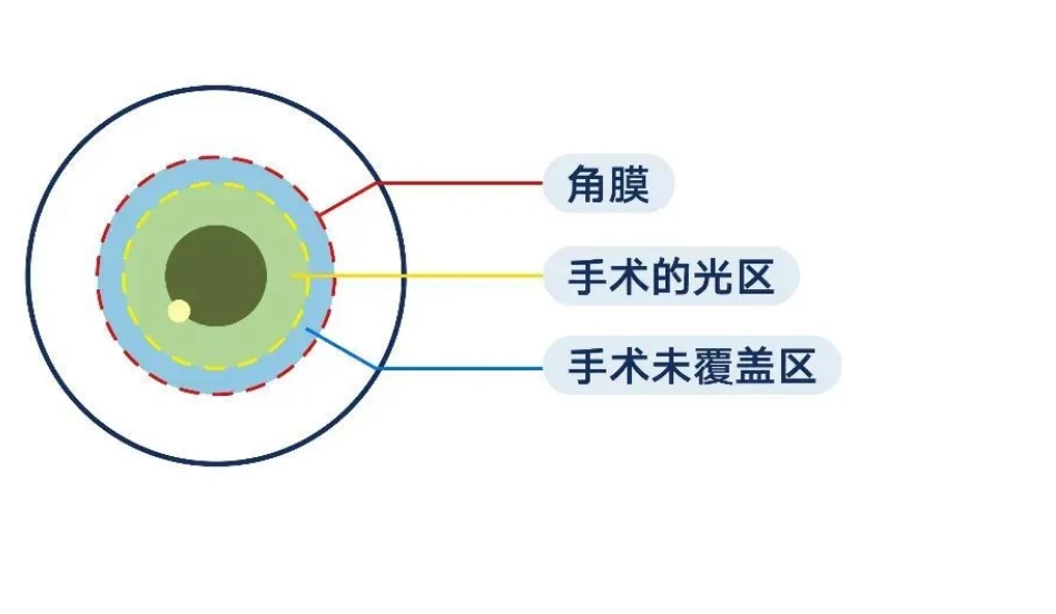 “暗瞳”是什么？听说有小伙伴因为它不能做近视手术？插图(2)