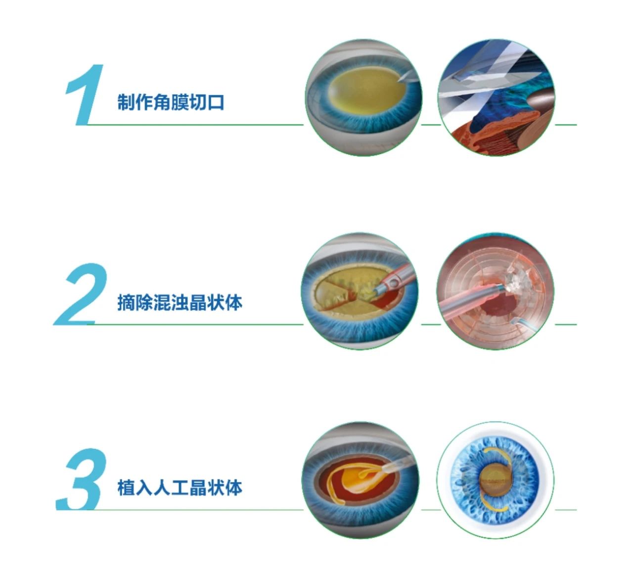 只是有点雾蒙蒙，轻微白内障会自己消失吗？插图(1)