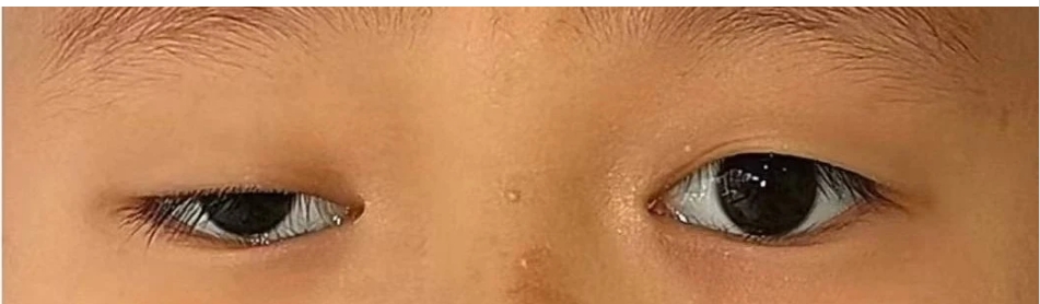 孩子眼睛一大一小，看似睡不醒，可能是上睑下垂惹的祸！插图(2)