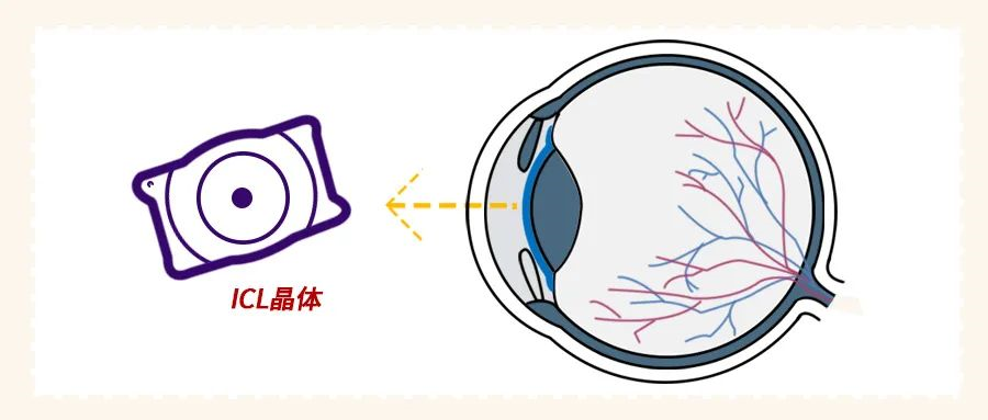 ICL晶体植入术 | 一项可逆的近视矫正手术插图