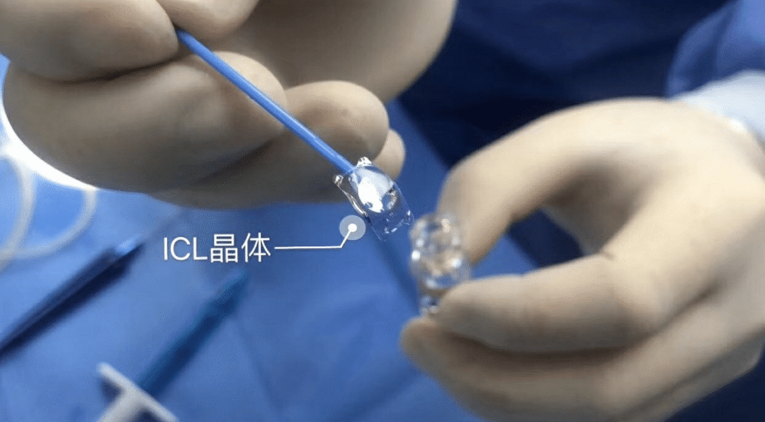 ICL晶体植入术 | 一项可逆的近视矫正手术插图(1)
