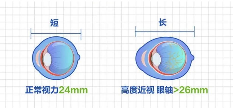 近视超过600度，建议去做这件事插图